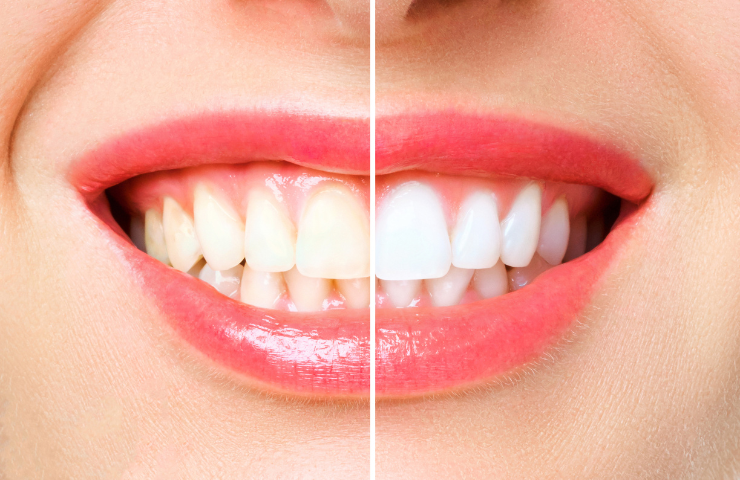 What Is The Safest Way To Whiten Your Teeth