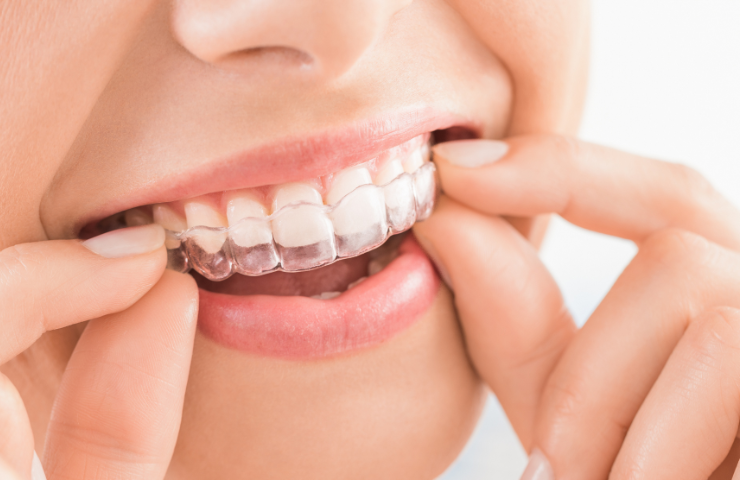 How Do Clear Aligners Work? A Step-By-Step Guide
