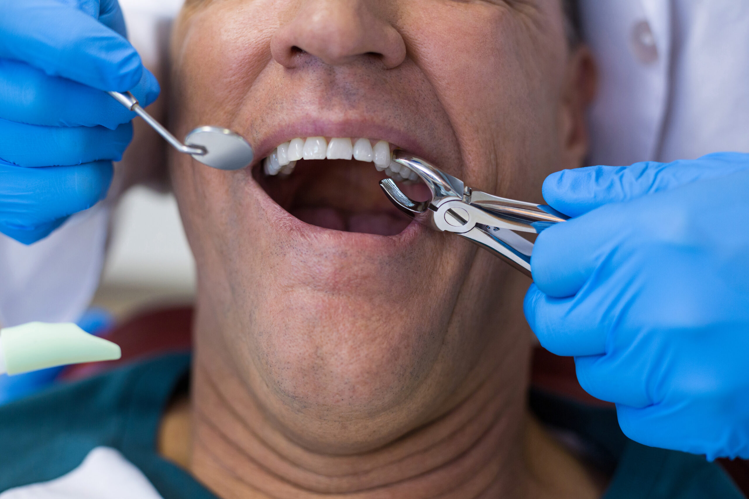 5 signs you need a tooth extraction