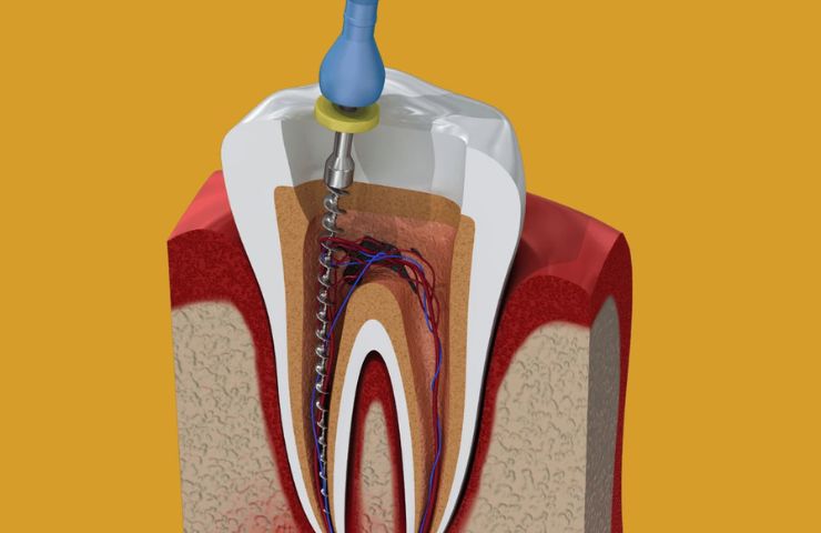 How Long Does It Take To Recover After a Root Canal Treatment?
