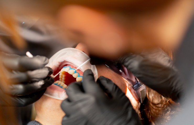 How Dental Fillings Can Save Your Smile