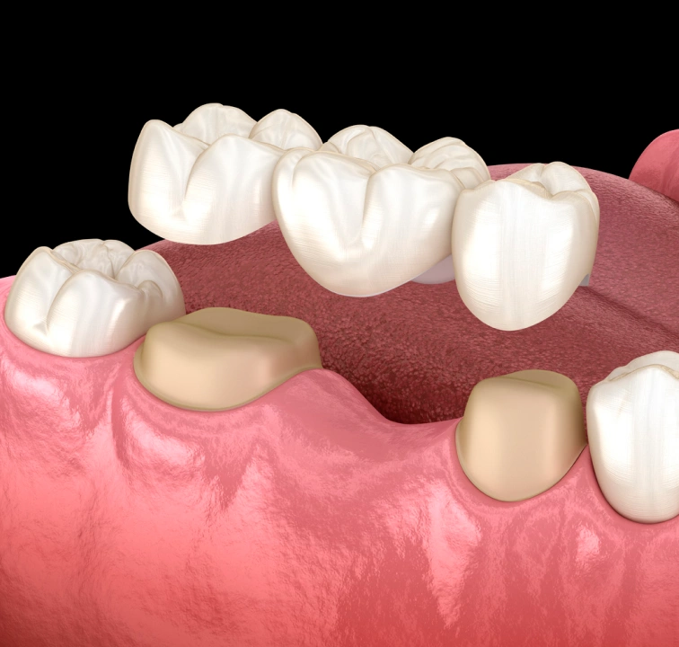Dental Crowns and Bridges
