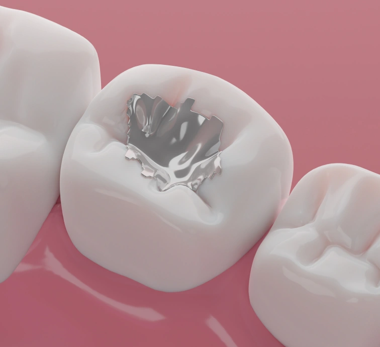 Discover Exceptional Dental Fillings