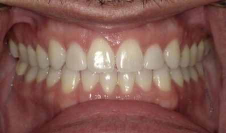 Tooth Extraction in Charlotte